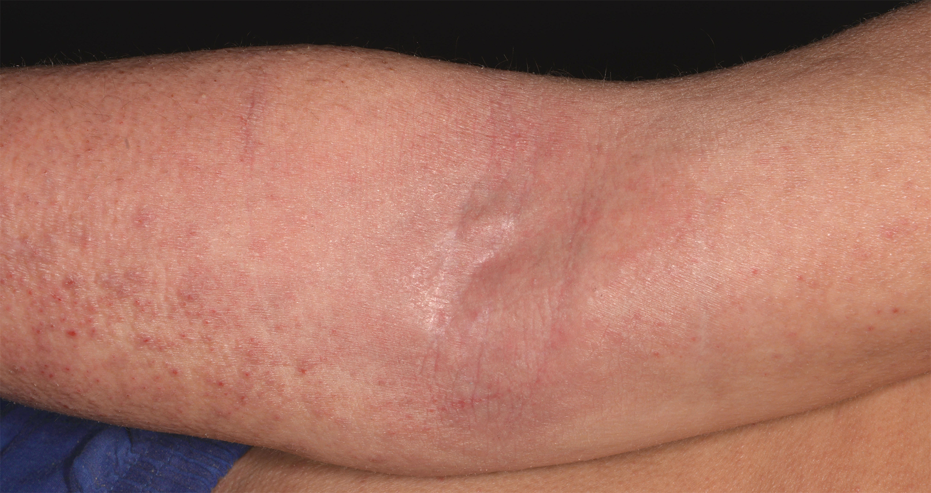 files/Dateien/Bilder/bieber-dermatology-consulting-bdc-neurodermitis-beuge-1920x1280px.jpg